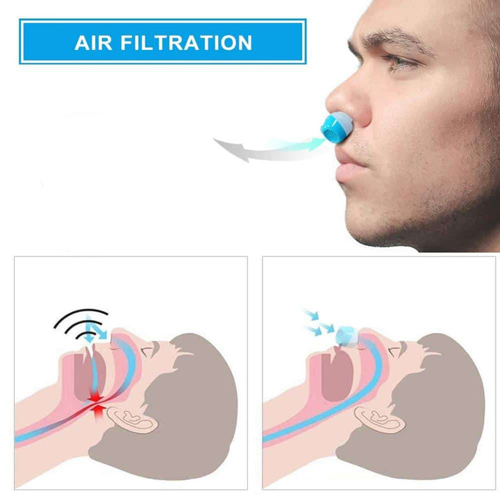 Anti-Snoring Device